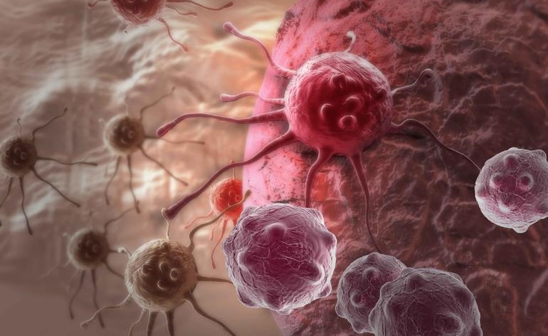 癌症早期一定要开刀吗