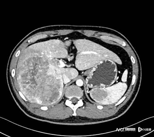 一个孩子为什么会得癌症